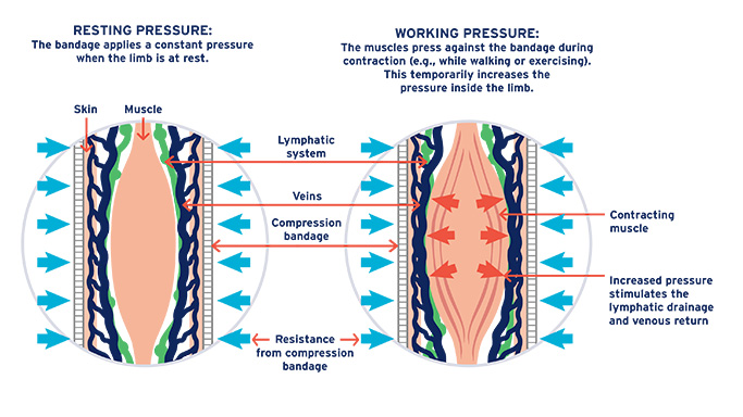 Lymphedema: Why and how compression therapy helps
